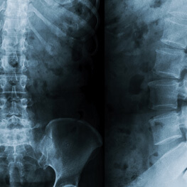 Minimally Invasive Spinal Surgery By The Best Neurosurgeons & Spinal Surgeons Sydney